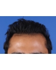 After Hair Transplant &nbsp;2 Sessions (Areas)